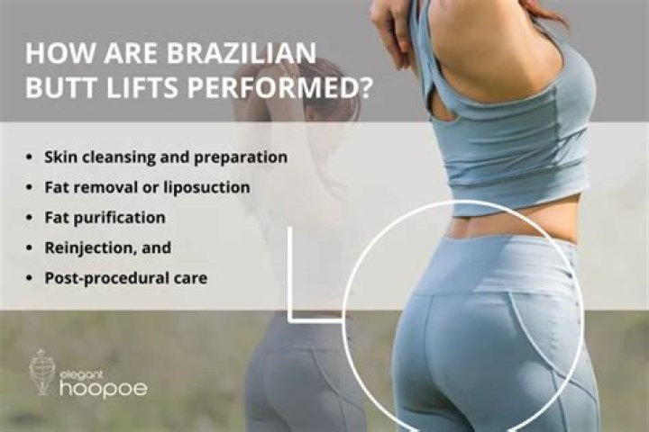 Are Brazilian Butt Lifts Still Popular with Celebrities?